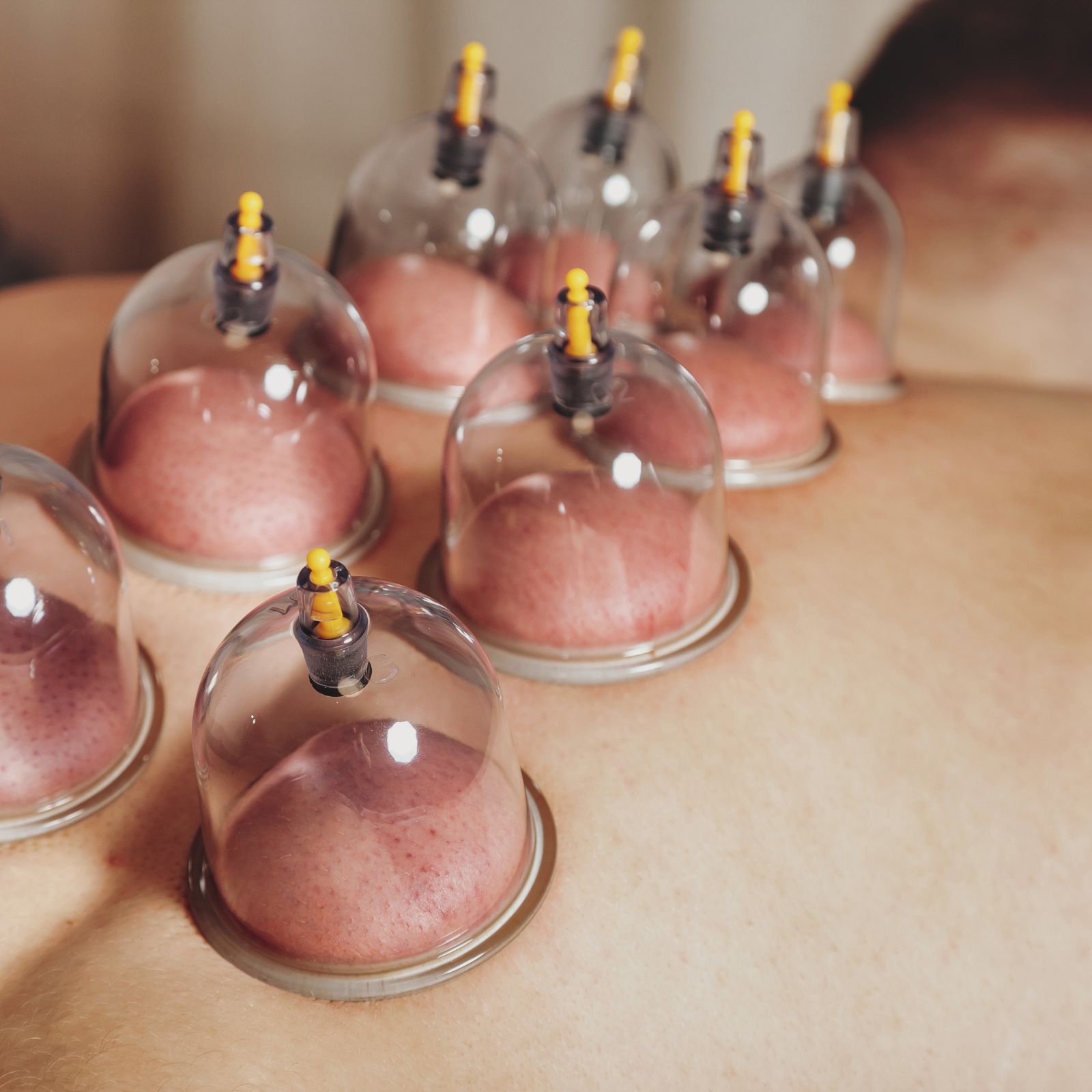 Schröpfkopfmassage — Schröpfgläser auf dem Rücken